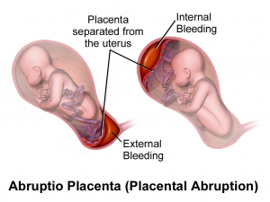 Placental Abruption and Cerebral Palsy