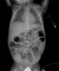 Necrotizing Enterocolitis Cerebral Palsy