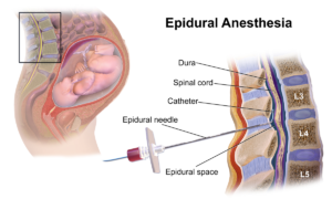 Cerebral Palsy Caused by an Anesthesia Error